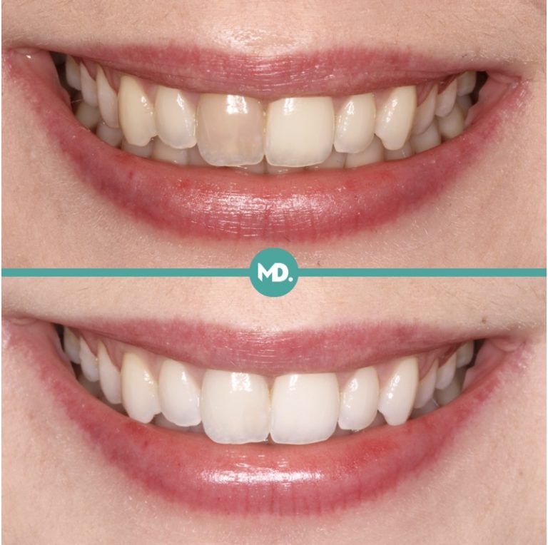 Internal Tooth Whitening Matt Dash Dentist