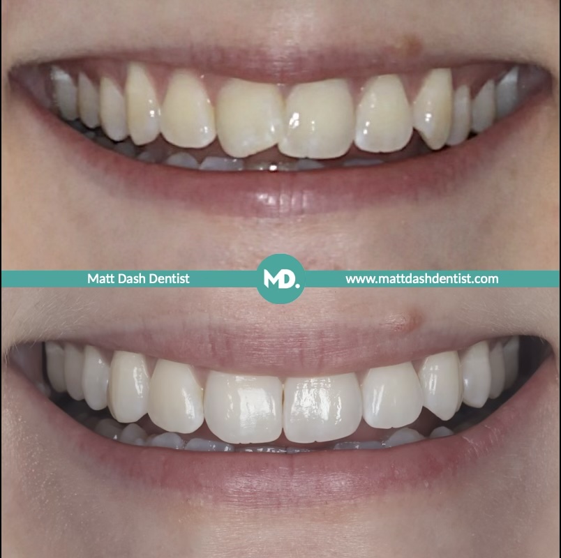 prevent tooth wear 1