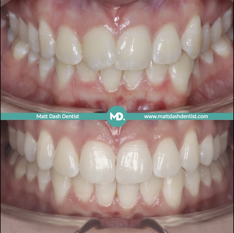 prevent tooth wear 2