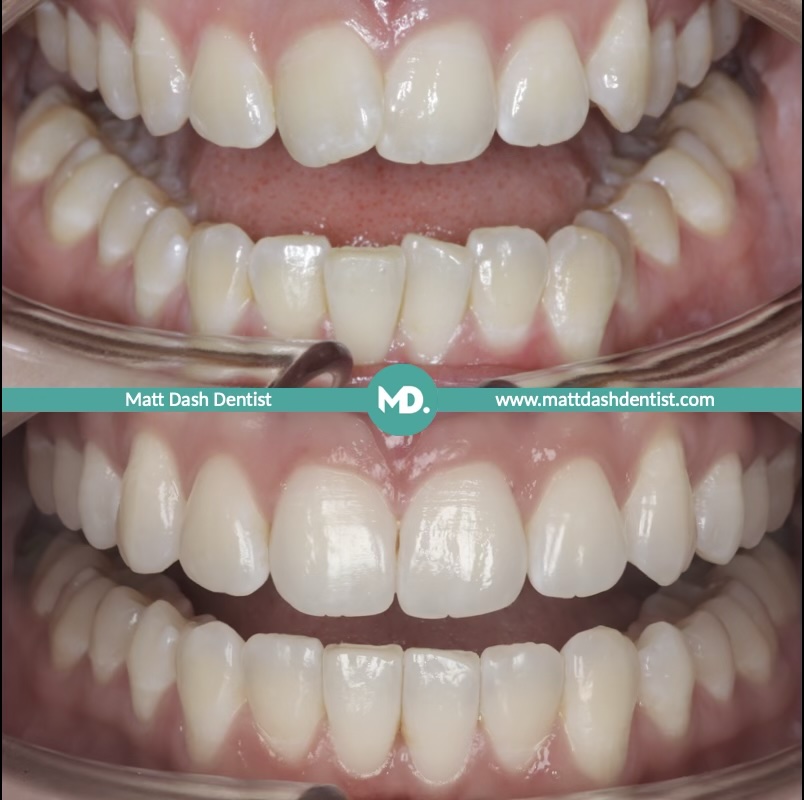 prevent tooth wear 3