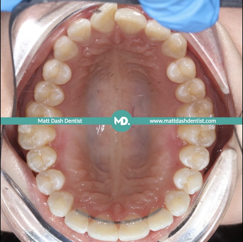 prevent tooth wear 4