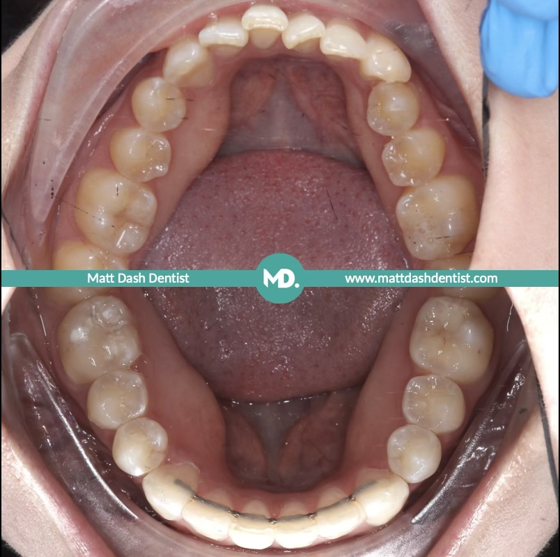 prevent tooth wear 5