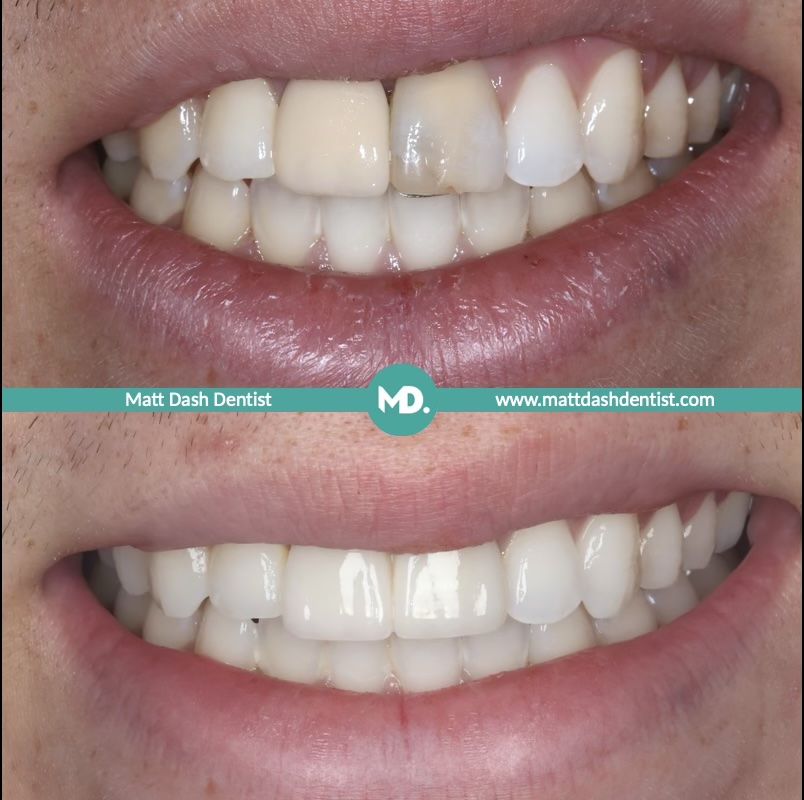 replace an old dental bridge 2