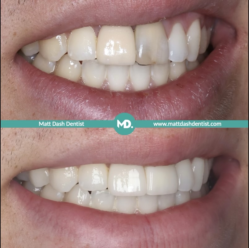 replace an old dental bridge 1
