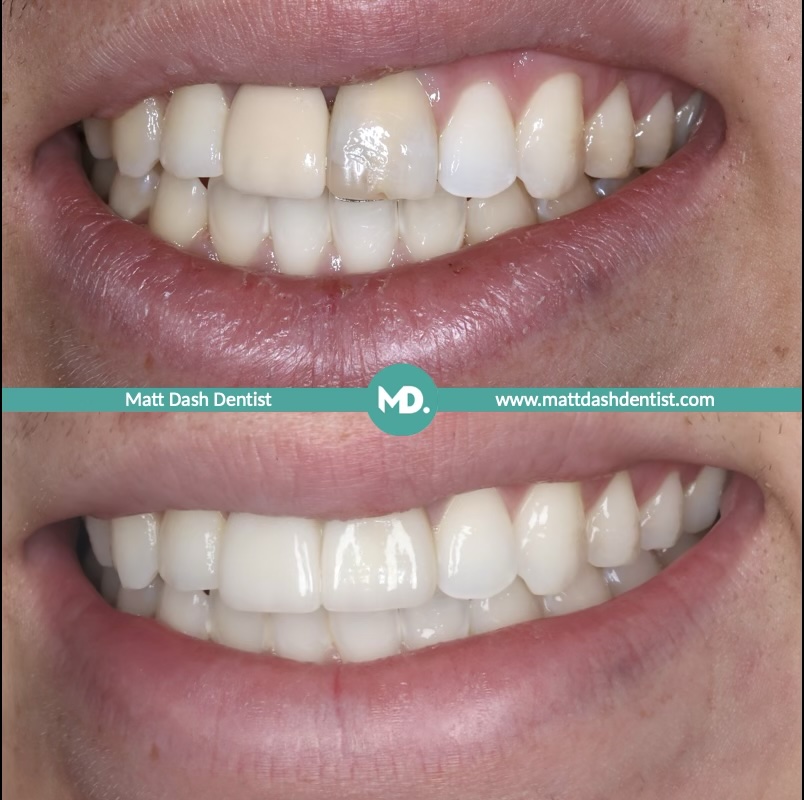 replace an old dental bridge 3