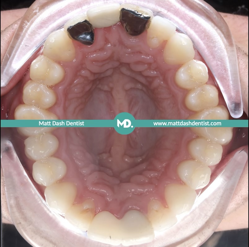 replace an old dental bridge 4